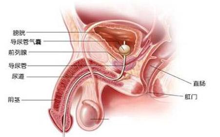 前列腺炎最新治疗技术及其步骤指南解析