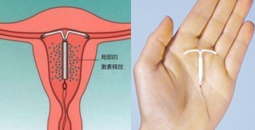 最新避孕法,最新避孕法，探索现代避孕技术的革新