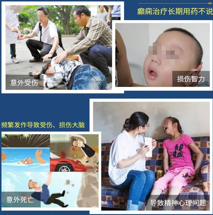 癫痫治疗方法